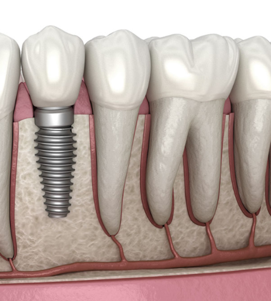 cnc-dental-implant