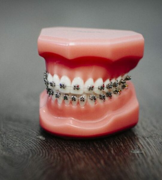 how-braces-work-straighten-teeth-1024x682-768x512