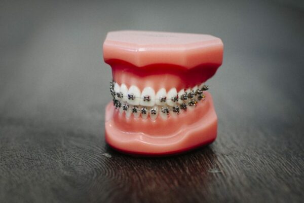 how-braces-work-straighten-teeth-1024x682-768x512