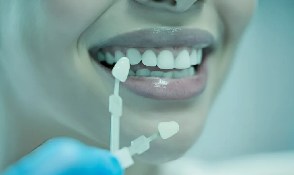 porcelain veneers in islamabad