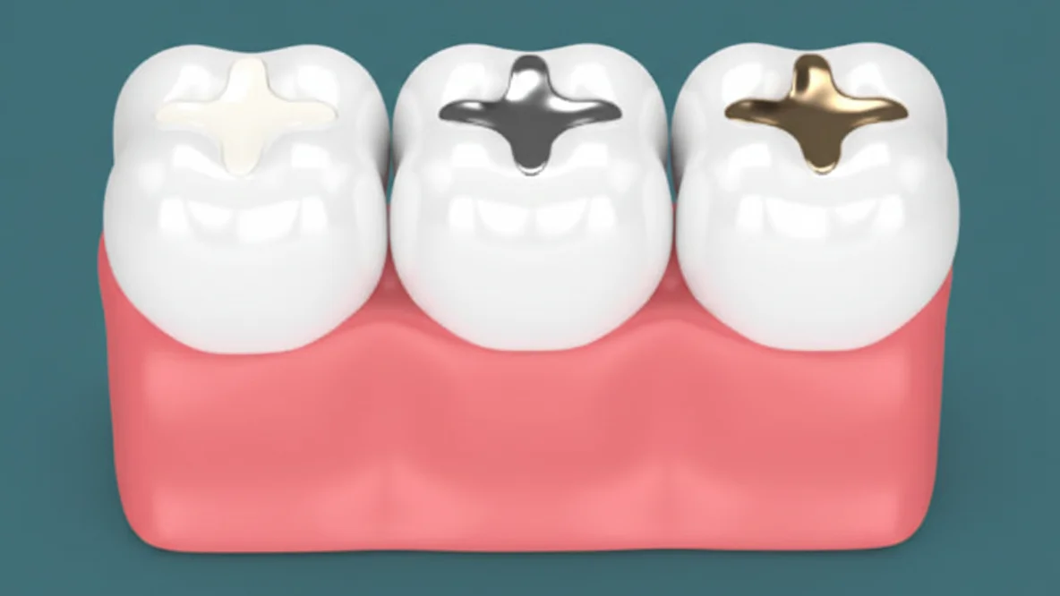 types of dental fillings