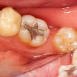 Amalgam tooth filling in islamabad