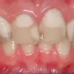 Glass ionomer tooth fillings in islamabad