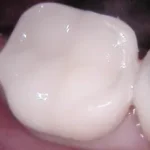 Ceramic tooth filling in islamabad