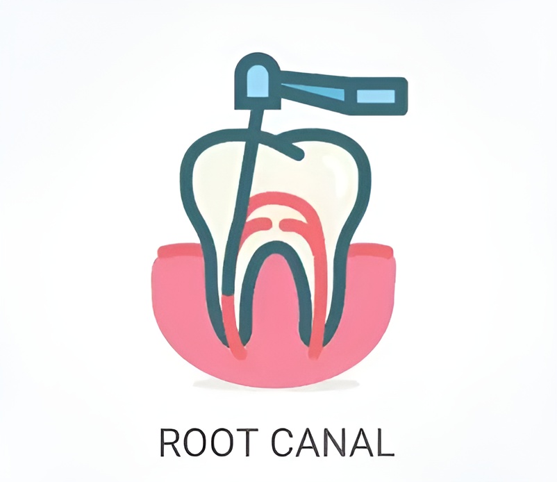 Root Canal Treatment 3 root canal treatment i islamabad
